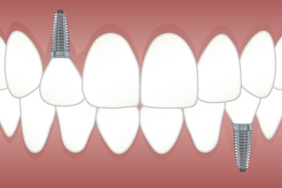 základní informace o zubních implantátech a kde nás najdete?